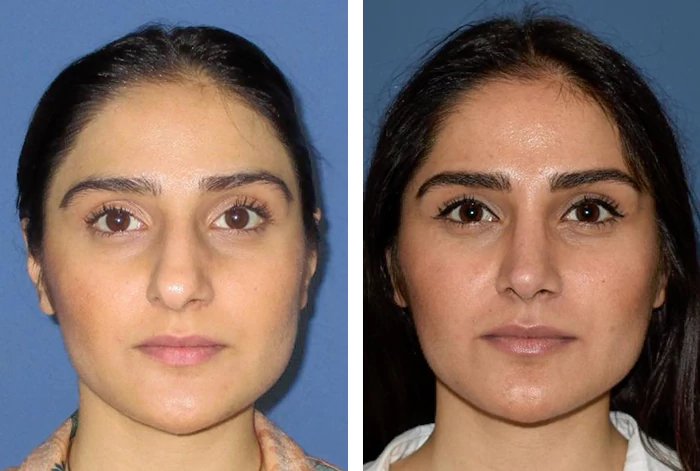 before & after photo of septoplasty