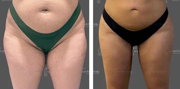 before & after photo of Thigh Lift