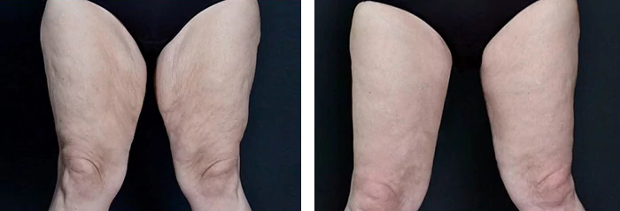 before & after photo of Thigh Lift