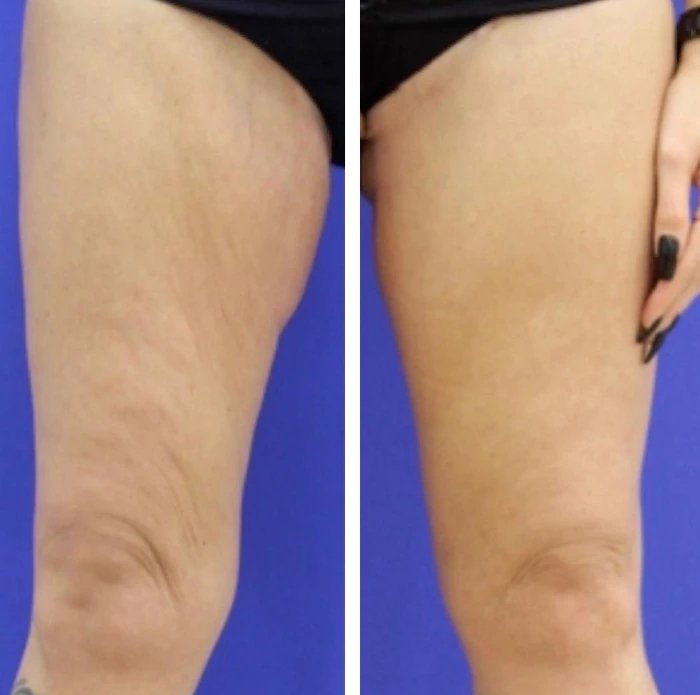 before & after photo of Thigh Lift