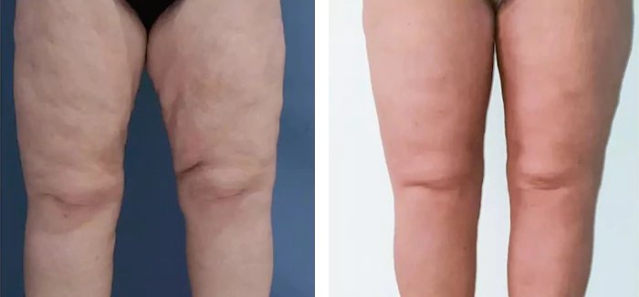 before & after photo of Liposuction