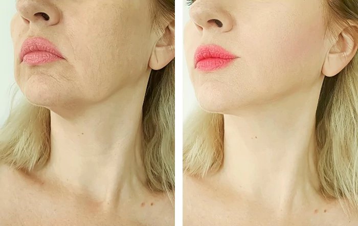 before & after photo of Thread Lift