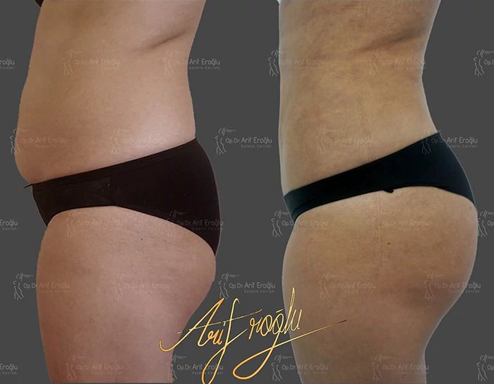 before & after photo of Body Lift