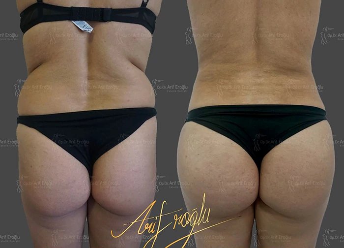 before & after photo of Body Lift