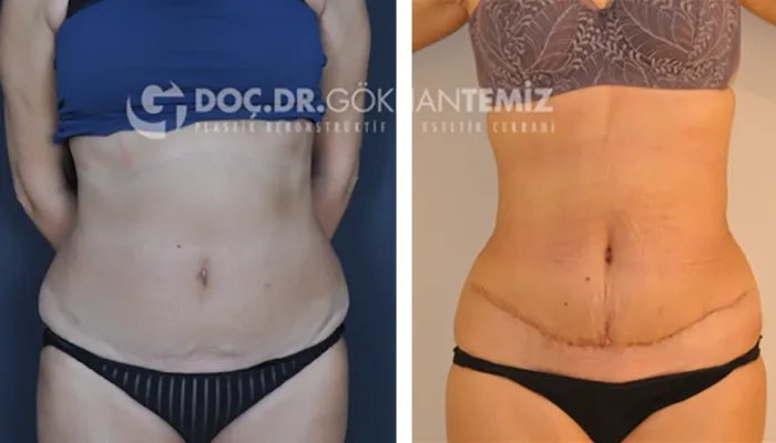 before & after photo of Tummy Tuck