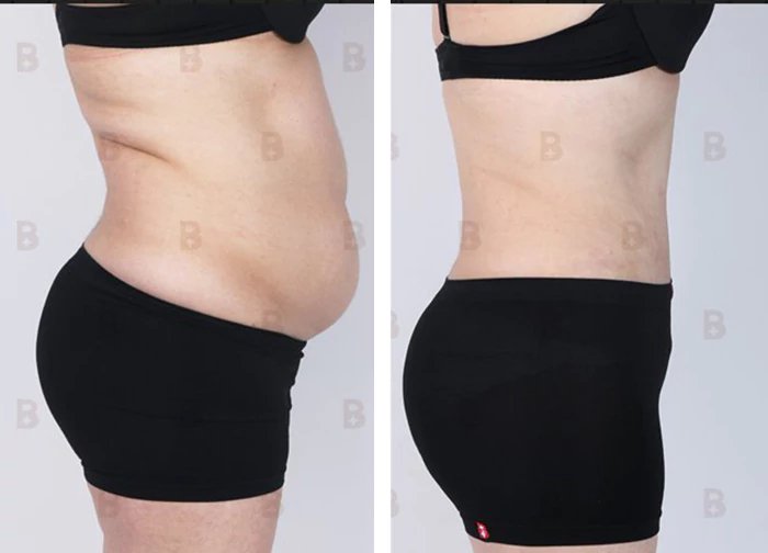 before & after photo of Body Lift