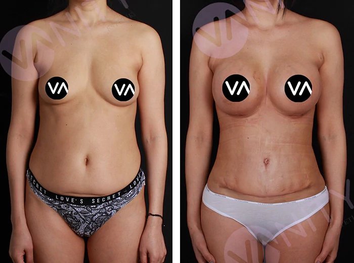 before & after photo of Tummy Tuck