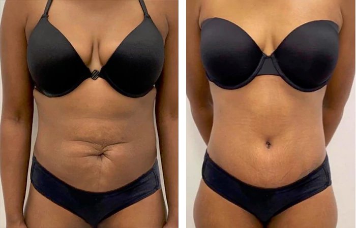 before & after photo of Liposuction