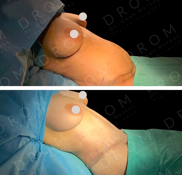 before & after photo of Tummy Tuck