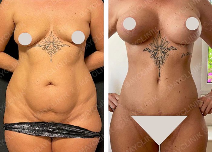 before & after photo of Tummy Tuck