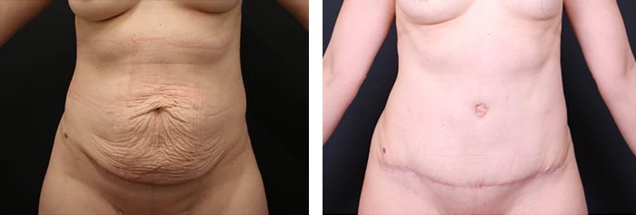 before & after photo of Breast Augmentation