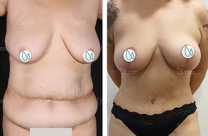 before & after photo of Tummy Tuck