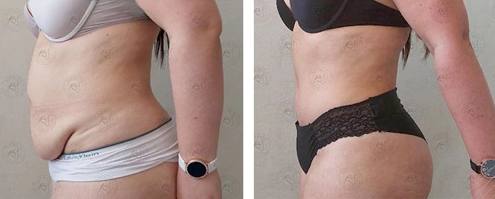 before & after photo of Tummy Tuck