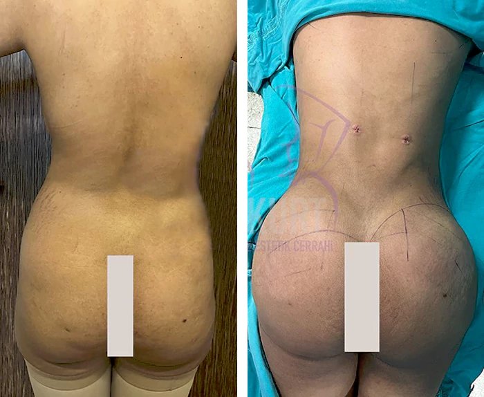 before & after photo of Brazilian Butt Lift