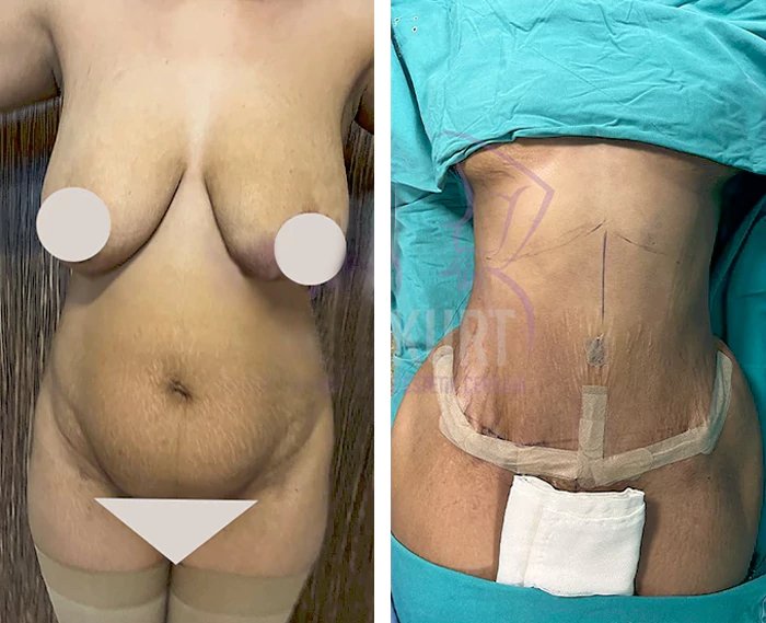 before & after photo of Brazilian Butt Lift