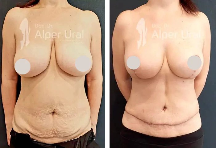 before & after photo of Breast Augmentation