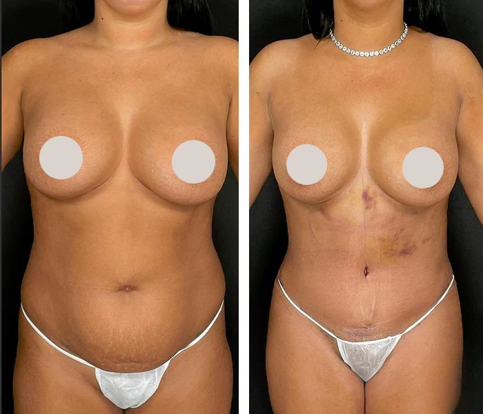 before & after photo of Tummy Tuck