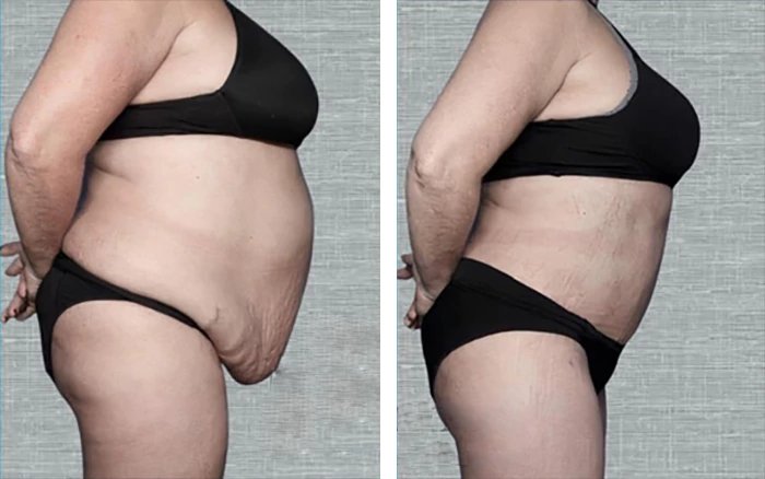 before & after photo of Tummy Tuck