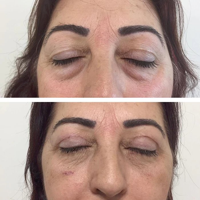 before & after photo of Eyelid Surgery