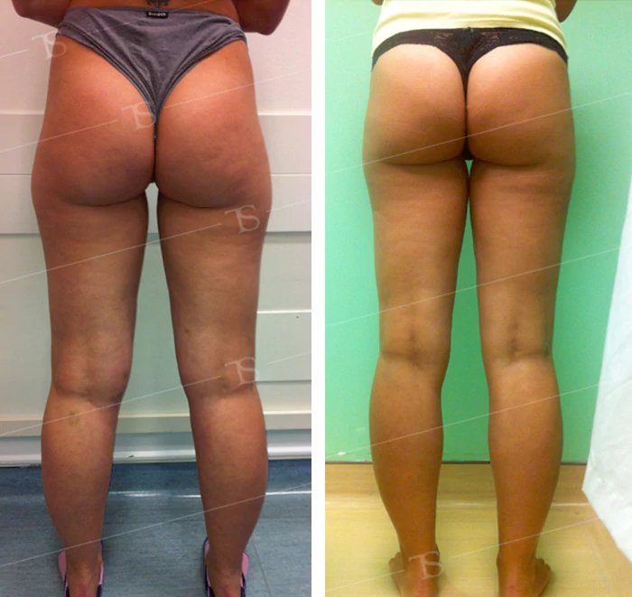 before & after photo of Thigh Lift