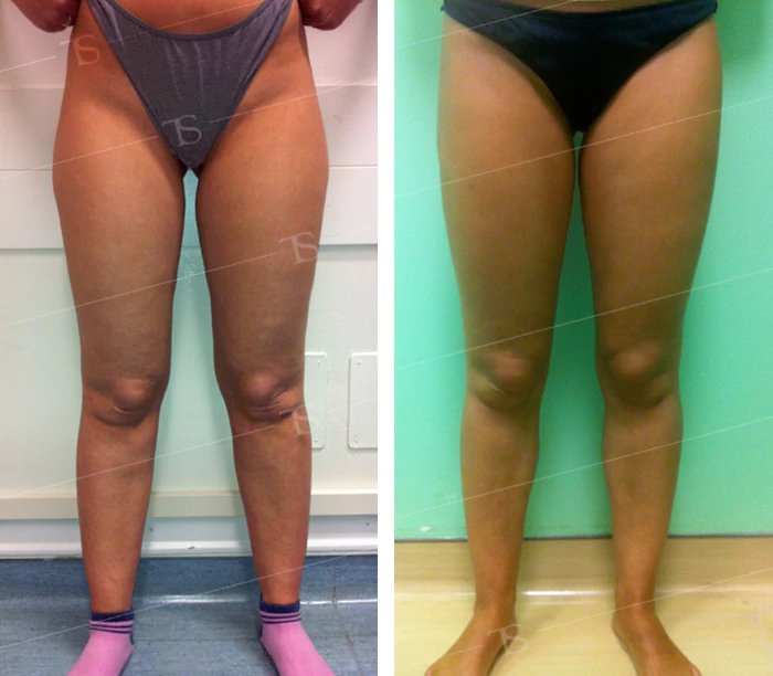 before & after photo of Thigh Lift