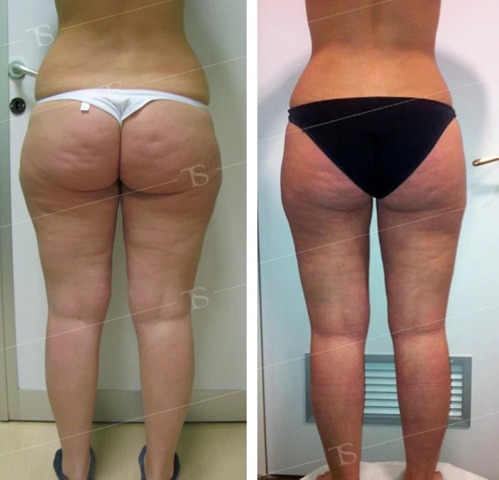 before & after photo of Thigh Lift