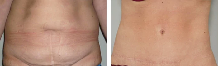 before & after photo of Abdominal Etching