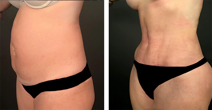 before & after photo of تقسيم عضلات البطن