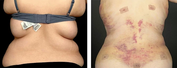 before & after photo of Abdominal Etching