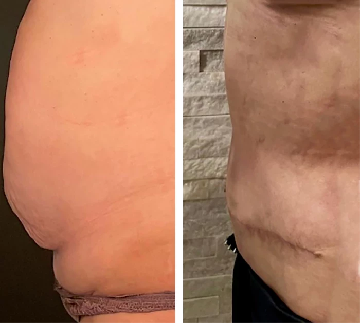 Abdominal Etching Before and After Photos