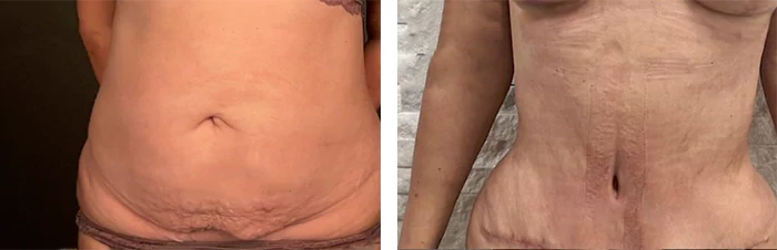 before & after photo of تقسيم عضلات البطن