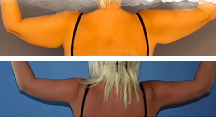 before & after photo of Breast Augmentation