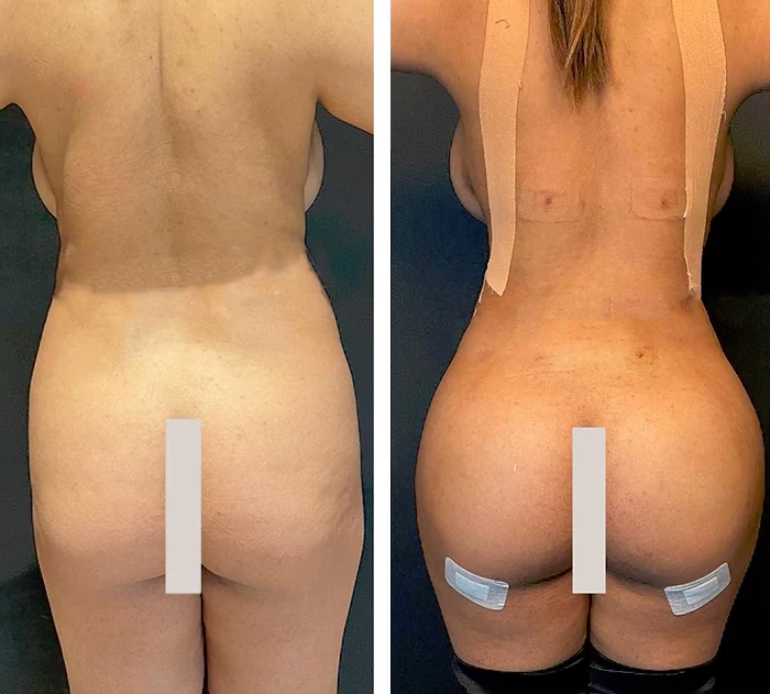 before & after photo of Brazilian Butt Lift