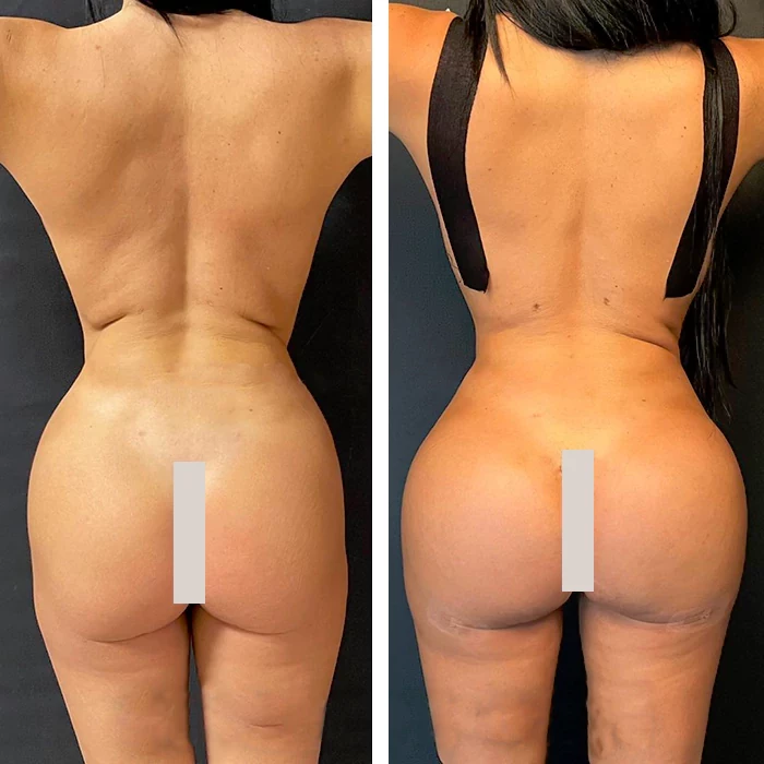 before & after photo of Brazilian Butt Lift