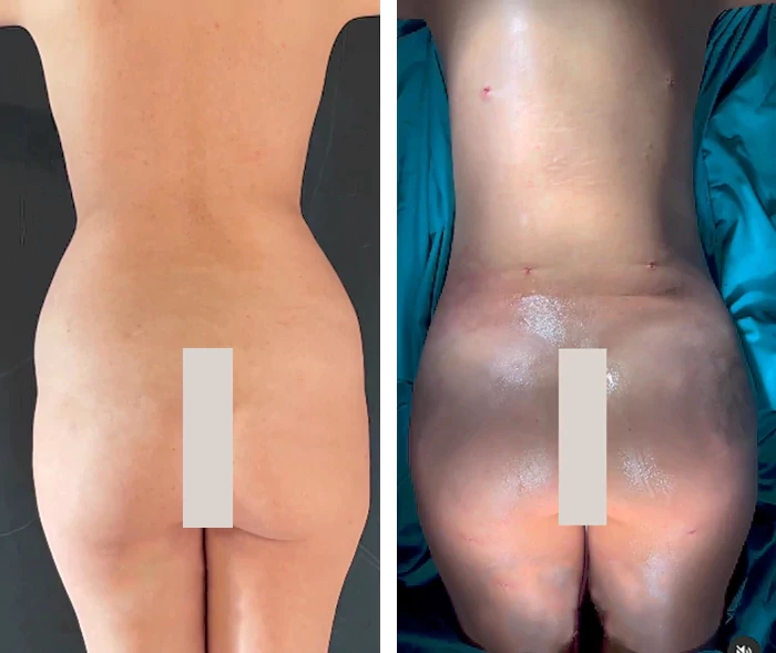 before & after photo of Brazilian Butt Lift