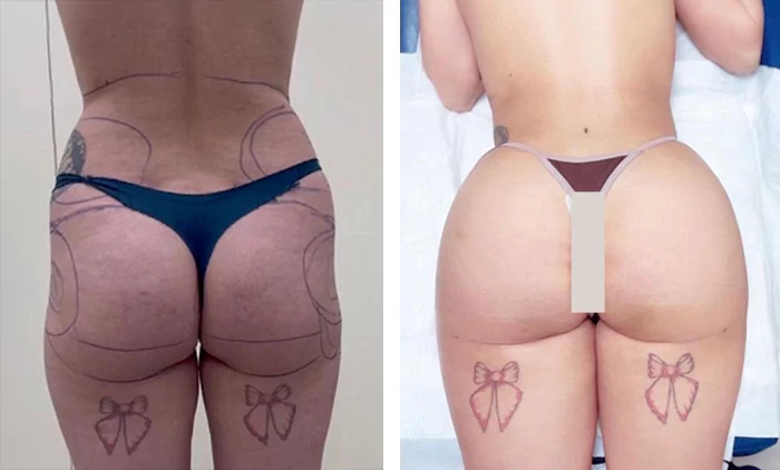 before & after photo of Tummy Tuck