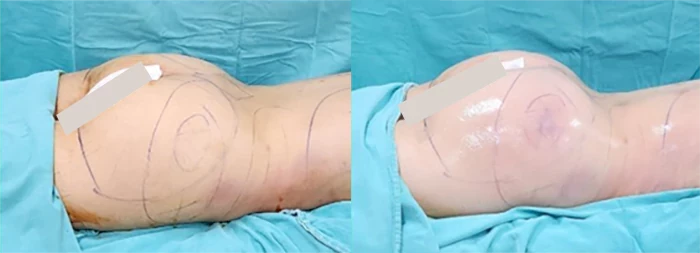 before & after photo of Tummy Tuck