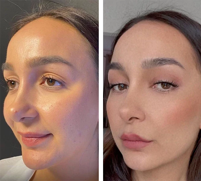 before & after photo of Facelift