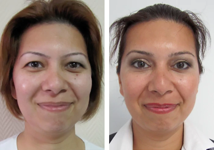 before & after photo of عملية تجميل الأنف