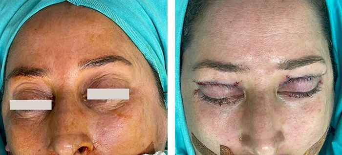 before & after photo of عملية تجميل الجفون