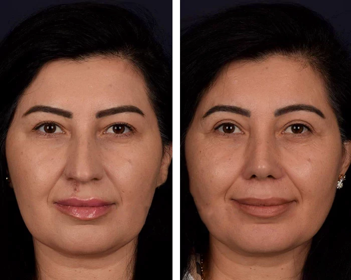 before & after photo of عملية تجميل الأنف