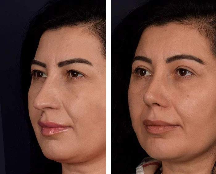 before & after photo of عملية تجميل الجفون