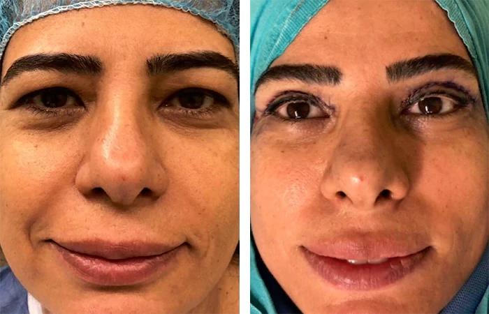 before & after photo of عملية تجميل الجفون