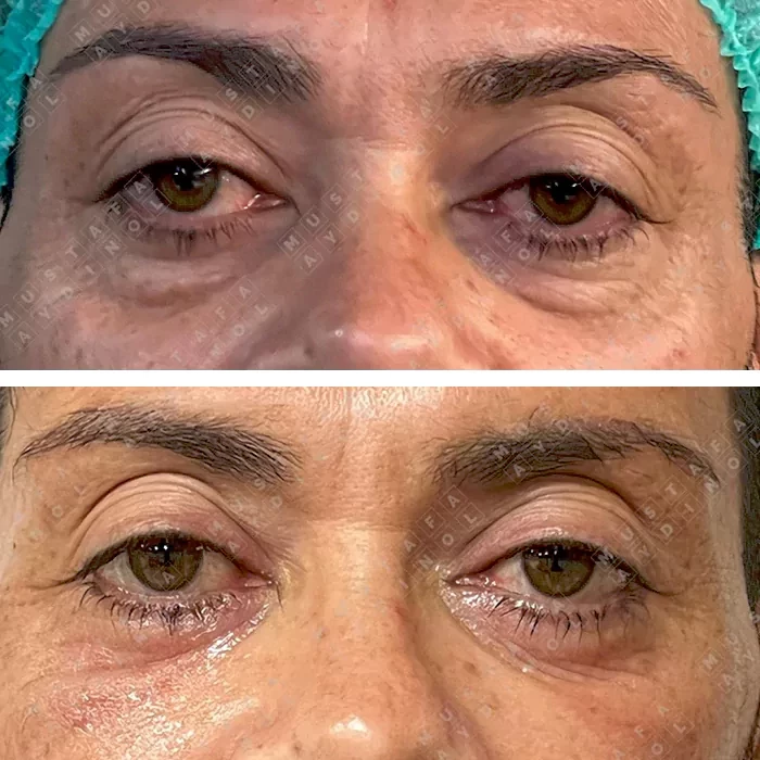 before & after photo of عملية تجميل الجفون