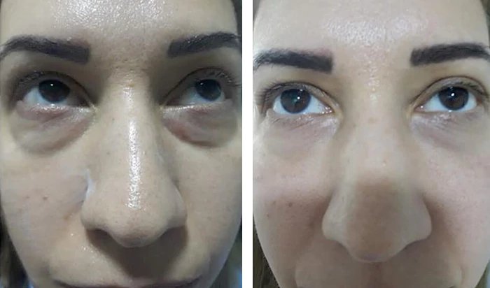 before & after photo of Thread Lift