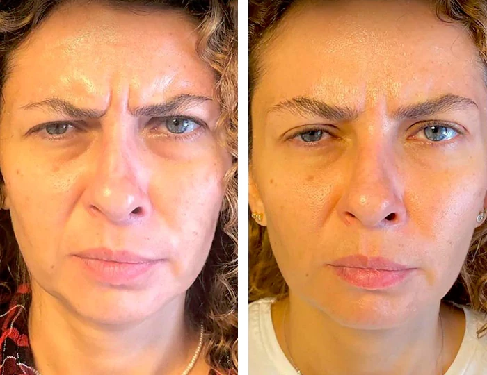 before & after photo of Facelift