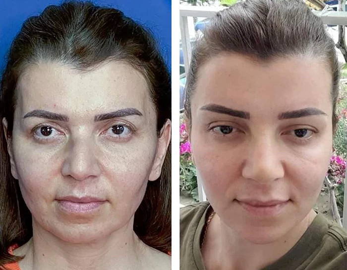 before & after photo of عملية تجميل الأنف