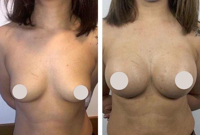 before & after photo of Tummy Tuck