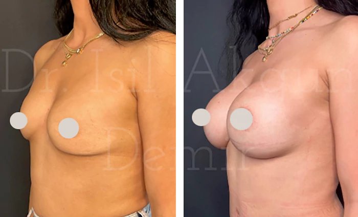 before & after photo of Breast Implants