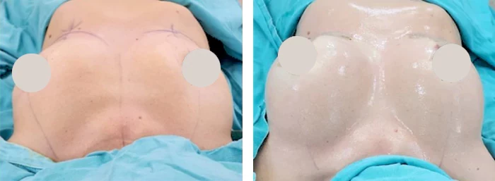 before & after photo of Tummy Tuck